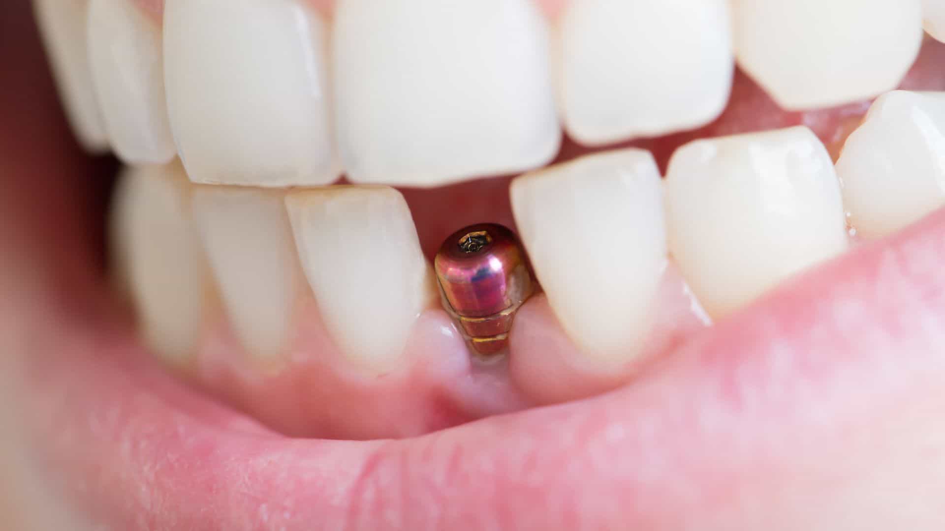 Why Choose Stonecrest Family Dental for Single Tooth Implants?