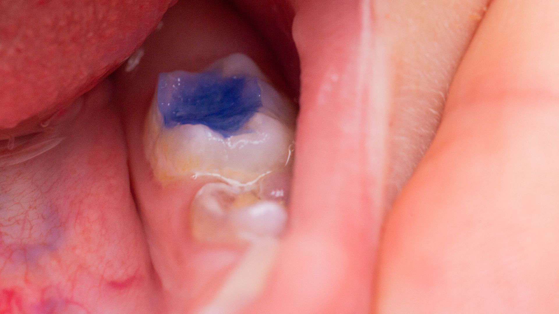 Transform Your Smile with Tooth Colored Fillings